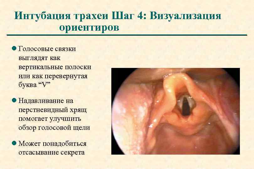 Интубация трахеи Шаг 4: Визуализация ориентиров l Голосовые связки выглядят как вертикальные полоски или