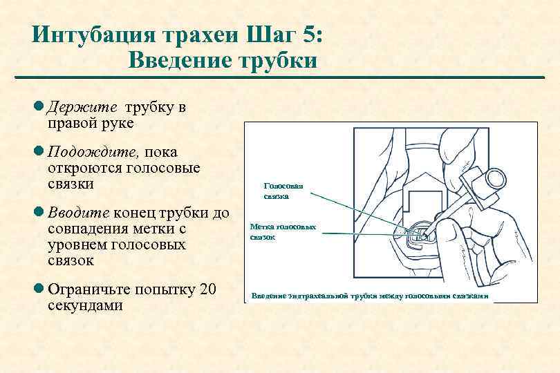 Интубация трахеи Шаг 5: Введение трубки l Держите трубку в правой руке l Подождите,