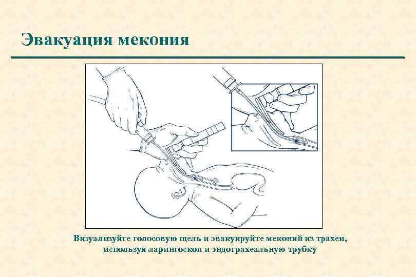 Эвакуация мекония Визуализуйте голосовую щель и эвакуируйте меконий из трахеи, используя ларингоскоп и эндотрахеальную