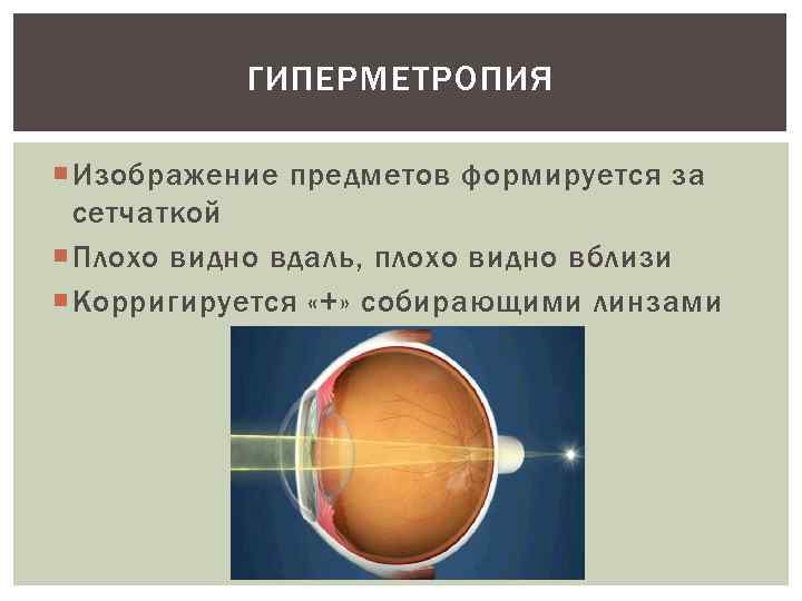 ГИПЕРМЕТРОПИЯ Изображение предметов формируется за сетчаткой Плохо видно вдаль, плохо видно вблизи Корригируется «+»