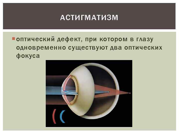 АСТИГМАТИЗМ оптический дефект, при котором в глазу одновременно существуют два оптических фокуса 