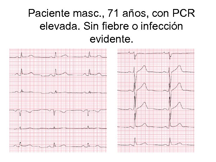 Paciente masc. , 71 años, con PCR elevada. Sin fiebre o infección evidente. 