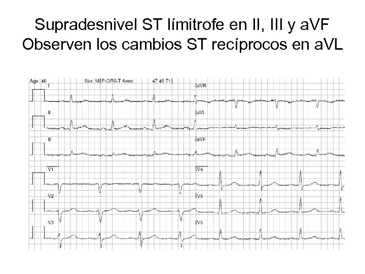 Supradesnivel ST límitrofe en II, III y a. VF Observen los cambios ST recíprocos