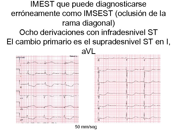 IMEST que puede diagnosticarse erróneamente como IMSEST (oclusión de la rama diagonal) Ocho derivaciones