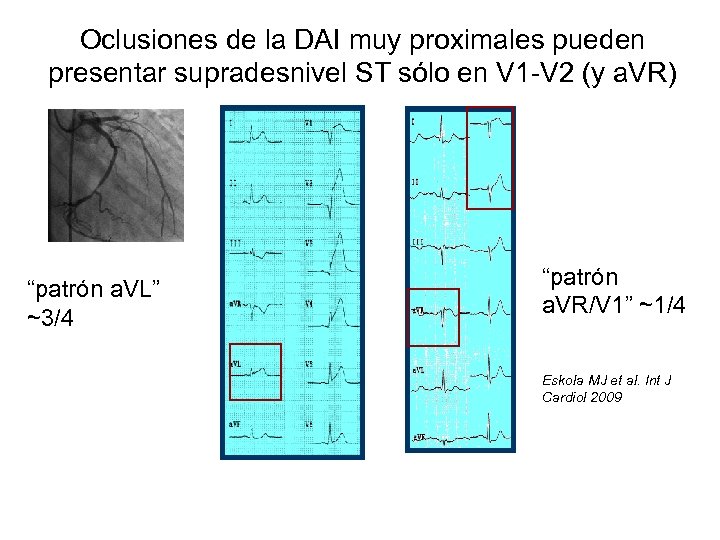 Oclusiones de la DAI muy proximales pueden presentar supradesnivel ST sólo en V 1