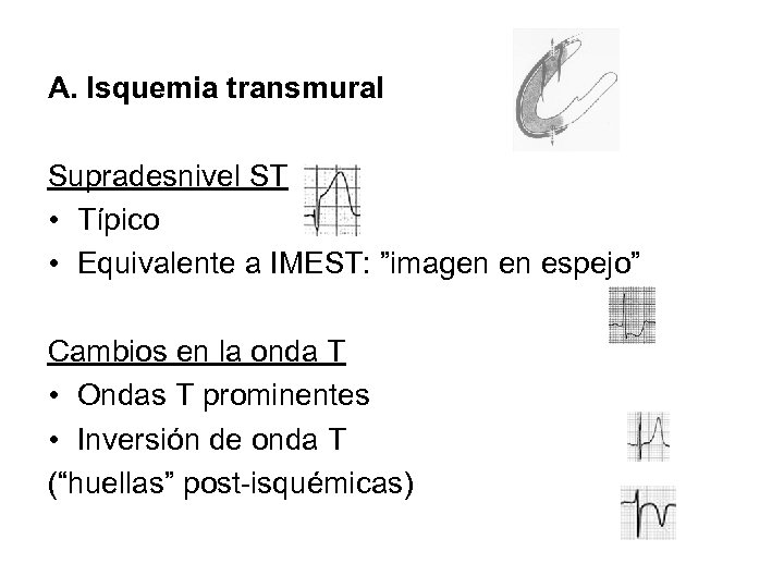 A. Isquemia transmural Supradesnivel ST • Típico • Equivalente a IMEST: ”imagen en espejo”