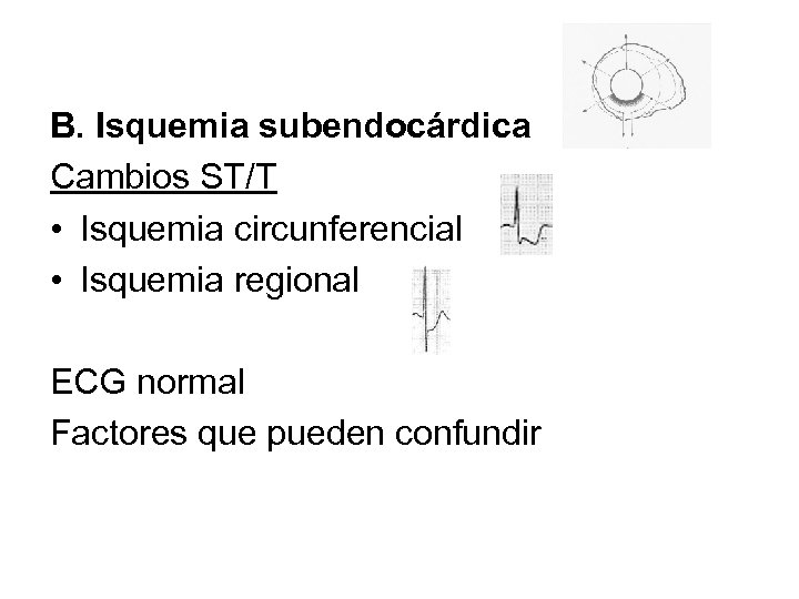 B. Isquemia subendocárdica Cambios ST/T • Isquemia circunferencial • Isquemia regional ECG normal Factores