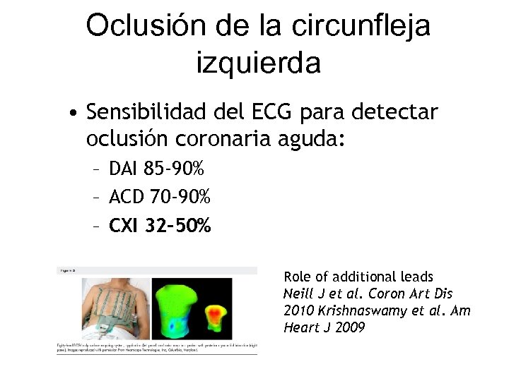 Oclusión de la circunfleja izquierda • Sensibilidad del ECG para detectar oclusión coronaria aguda: