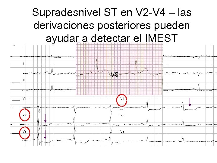 Supradesnivel ST en V 2 -V 4 – las derivaciones posteriores pueden ayudar a