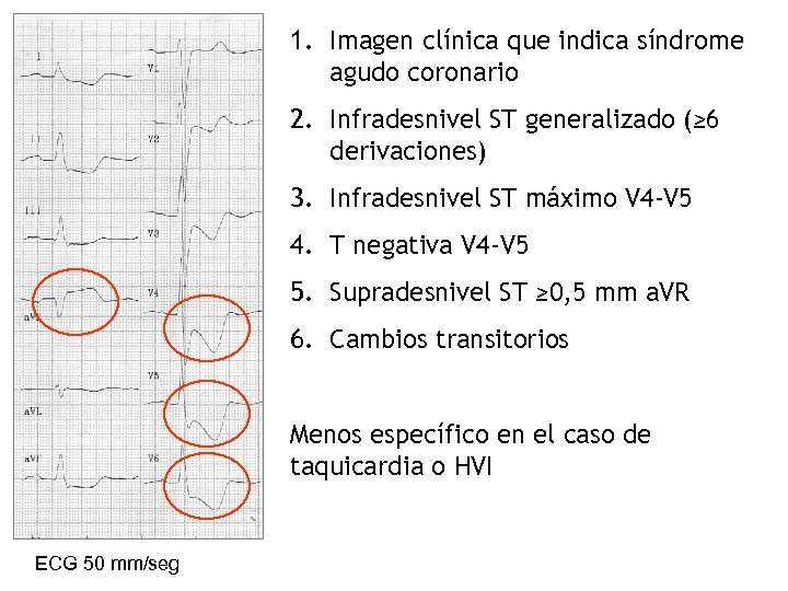 1. Imagen clínica que indica síndrome agudo coronario 2. Infradesnivel ST generalizado (≥ 6