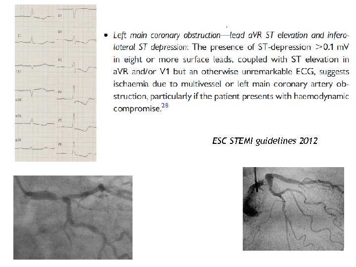 ESC STEMI guidelines 2012 