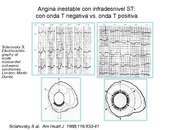 Angina inestable con infradesnivel ST: con onda T negativa vs. onda T positiva Sclarovsky