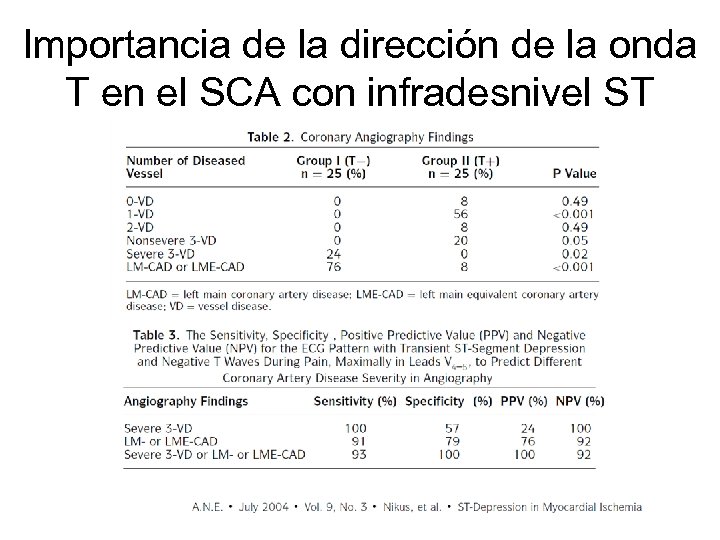 Importancia de la dirección de la onda T en el SCA con infradesnivel ST