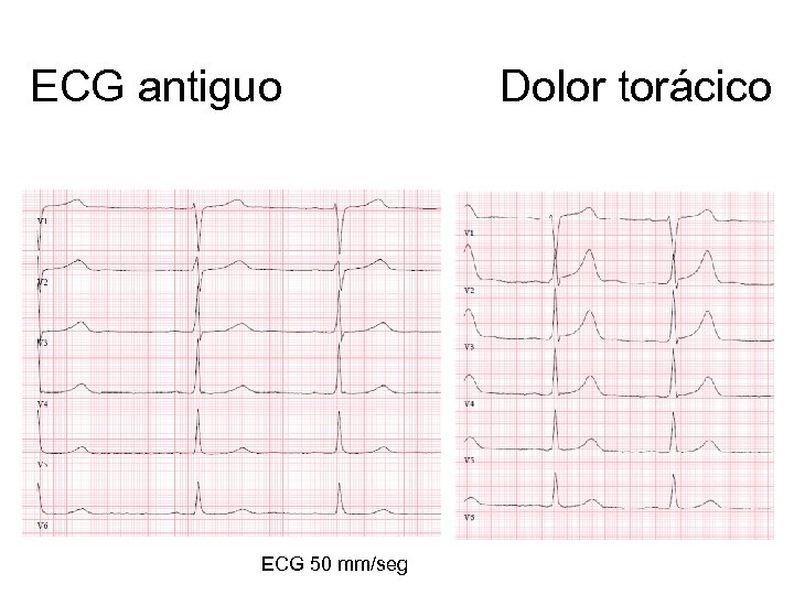 ECG antiguo ECG 50 mm/seg Dolor torácico 