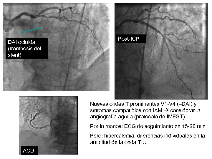 DAI ocluída (trombosis del stent) Post-ICP Nuevas ondas T prominentes V 1 -V 4