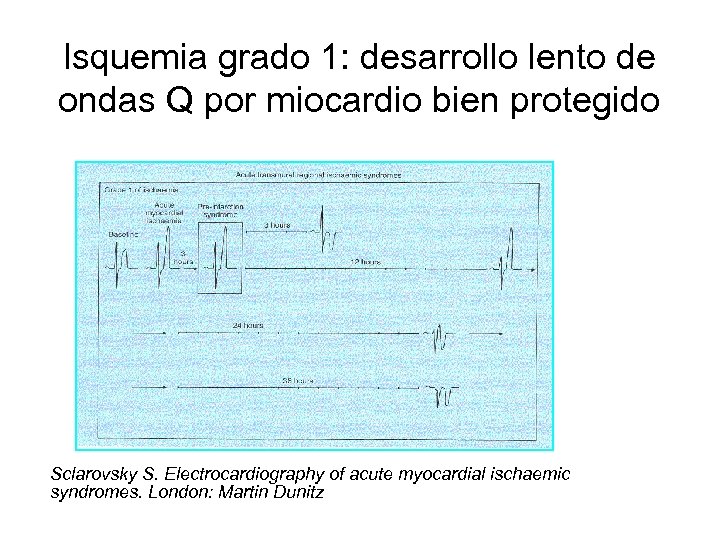 Isquemia grado 1: desarrollo lento de ondas Q por miocardio bien protegido Sclarovsky S.