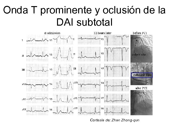 Onda T prominente y oclusión de la DAI subtotal Cortesía de: Zhan Zhong-qun 