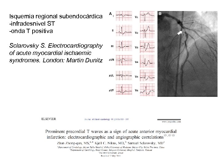 Isquemia regional subendocárdica -infradesnivel ST -onda T positiva Sclarovsky S. Electrocardiography of acute myocardial