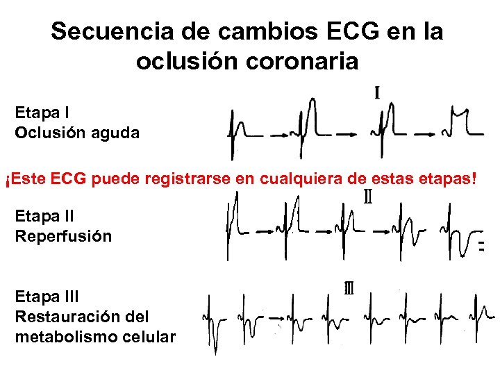 Secuencia de cambios ECG en la oclusión coronaria Etapa I Oclusión aguda ¡Este ECG