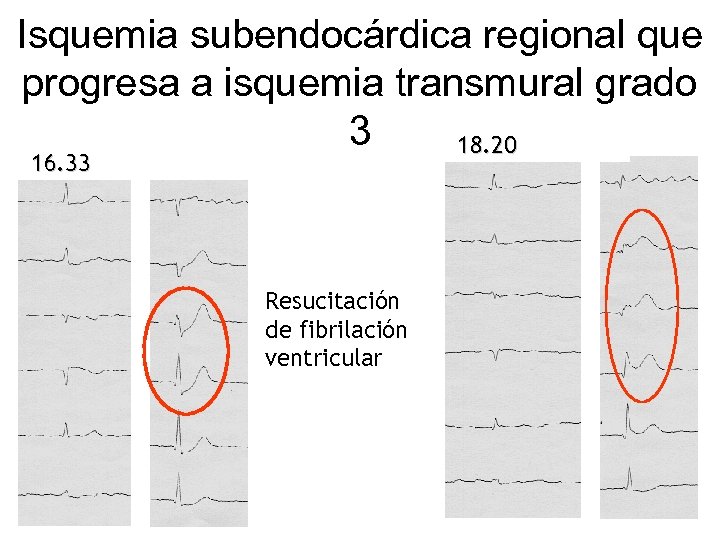 Isquemia subendocárdica regional que progresa a isquemia transmural grado 3 18. 20 16. 33