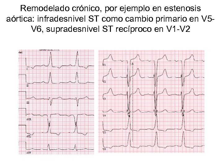 Remodelado crónico, por ejemplo en estenosis aórtica: infradesnivel ST como cambio primario en V