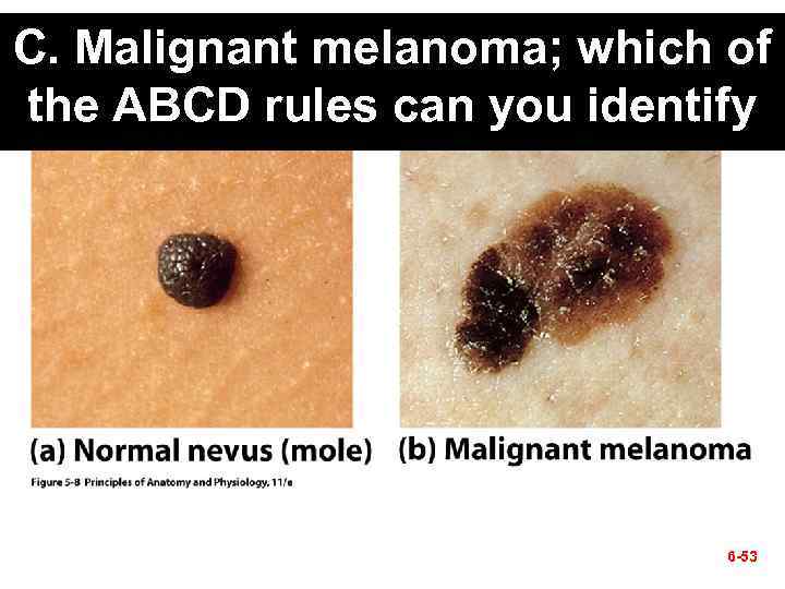 C. Malignant melanoma; which of the ABCD rules can you identify 6 -53 