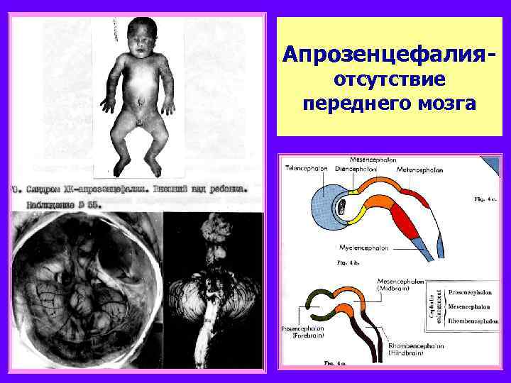 Апрозенцефалияотсутствие переднего мозга 