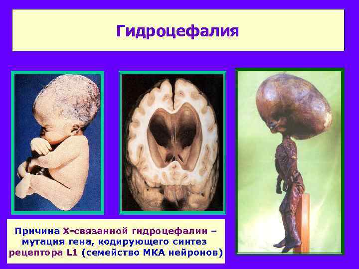 Гидроцефалия Причина Х-связанной гидроцефалии – мутация гена, кодирующего синтез рецептора L 1 (семейство МКА