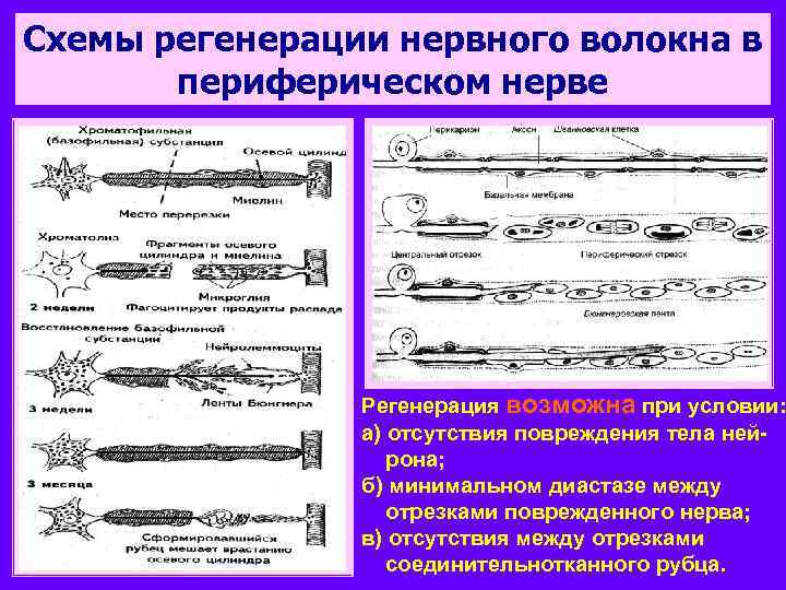 Схемы регенерации нервного волокна в периферическом нерве Регенерация возможна при условии: а) отсутствия повреждения