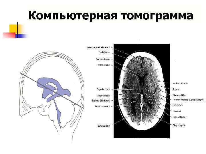 Компьютерная томограмма 