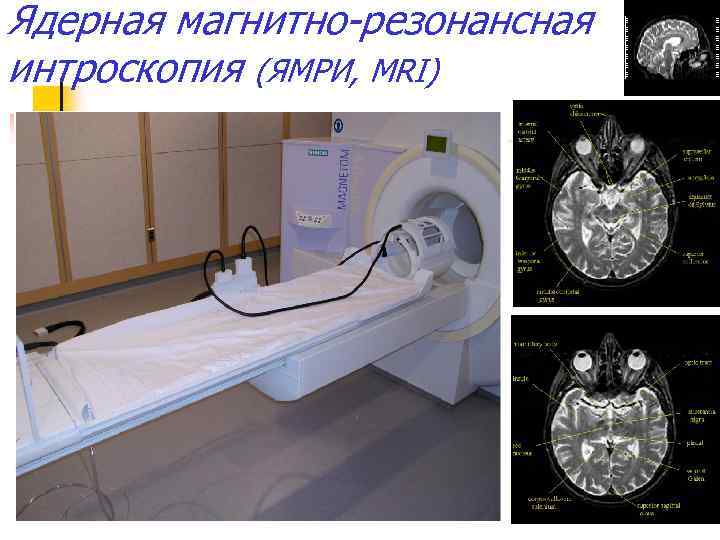 Ядерная магнитно-резонансная интроскопия (ЯМРИ, MRI) 