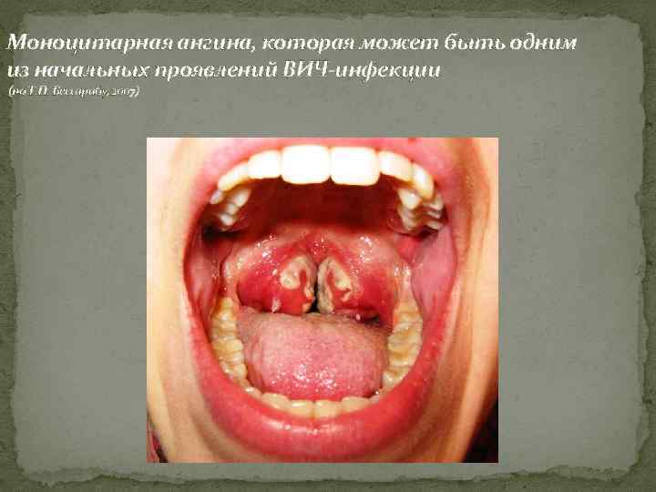 Моноцитарная ангина, которая может быть одним из начальных проявлений ВИЧ-инфекции (по Т. П. Бессарабу,
