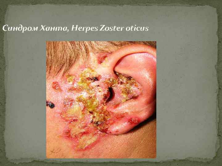 Синдром Ханта, Herpes Zoster oticus 