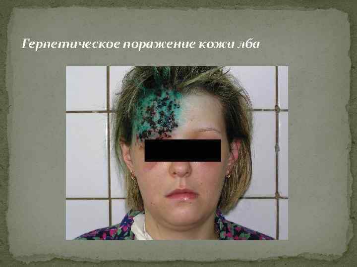 Герпетическое поражение кожи лба 