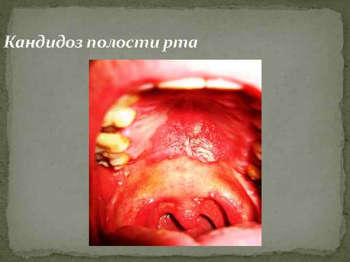 Кандидоз полости рта 