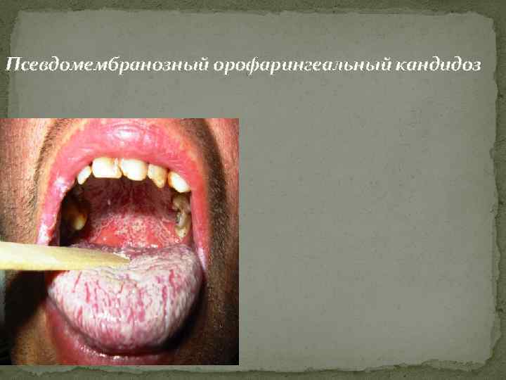 Псевдомембранозный орофарингеальный кандидоз 
