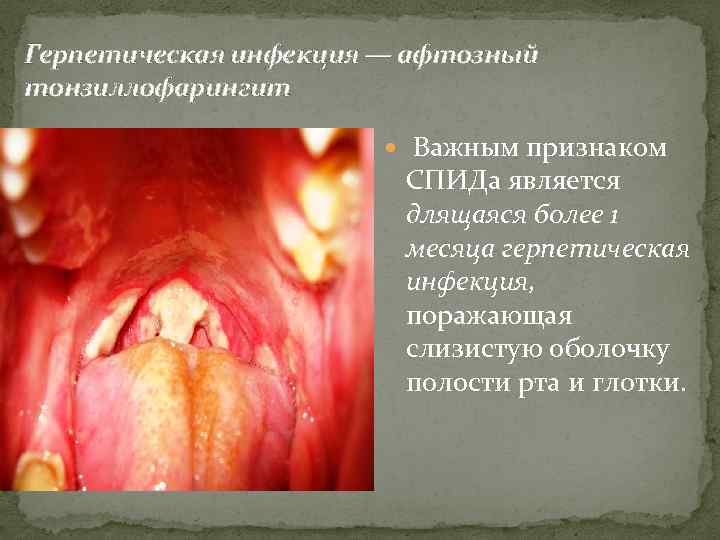 Герпетическая инфекция — афтозный тонзиллофарингит Важным признаком СПИДа является длящаяся более 1 месяца герпетическая