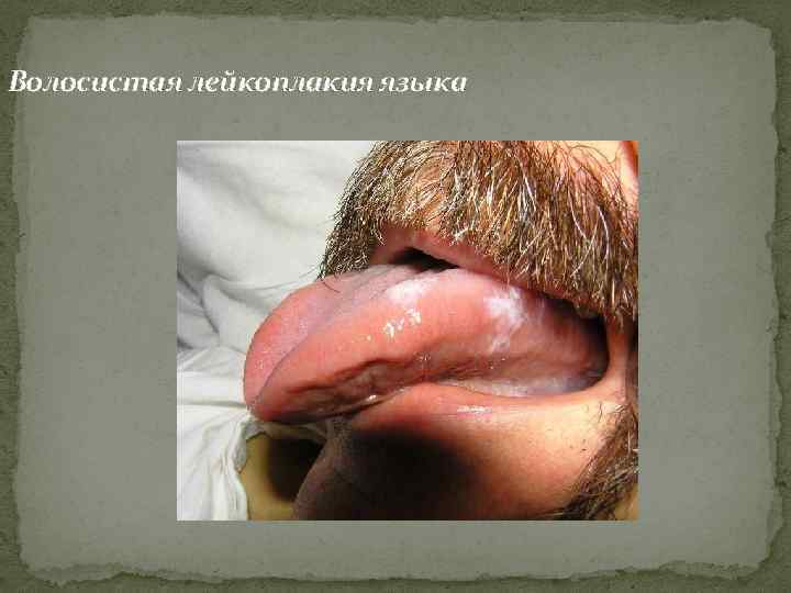 Волосистая лейкоплакия языка 