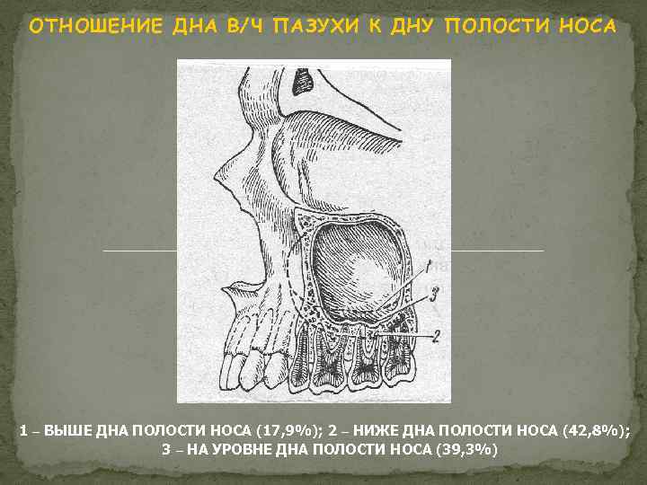 ОТНОШЕНИЕ ДНА В/Ч ПАЗУХИ К ДНУ ПОЛОСТИ НОСА 1 – ВЫШЕ ДНА ПОЛОСТИ НОСА