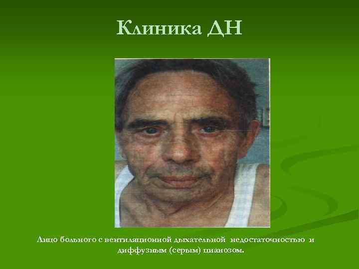 Клиника ДН Лицо больного с вентиляционной дыхательной недостаточностью и диффузным (серым) цианозом. 