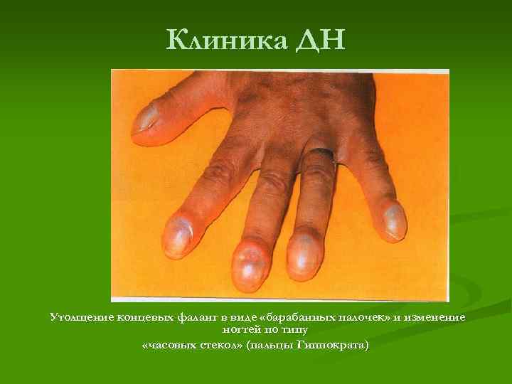 Клиника ДН Утолщение концевых фаланг в виде «барабанных палочек» и изменение ногтей по типу