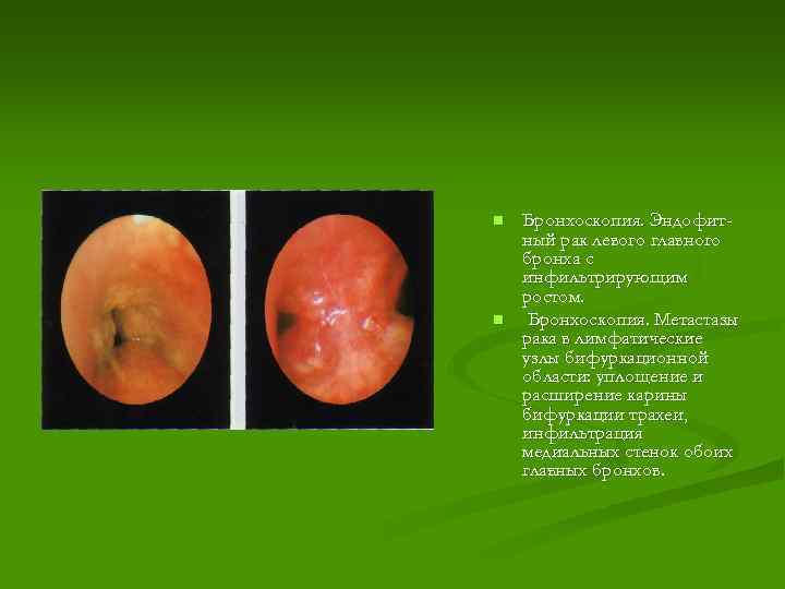 n n Бронхоскопия. Эндофитный рак левого главного бронха с инфильтрирующим ростом. Бронхоскопия. Метастазы рака