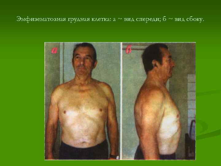 Эмфизематозная грудная клетка: а ~ вид спереди; б ~ вид сбоку. 