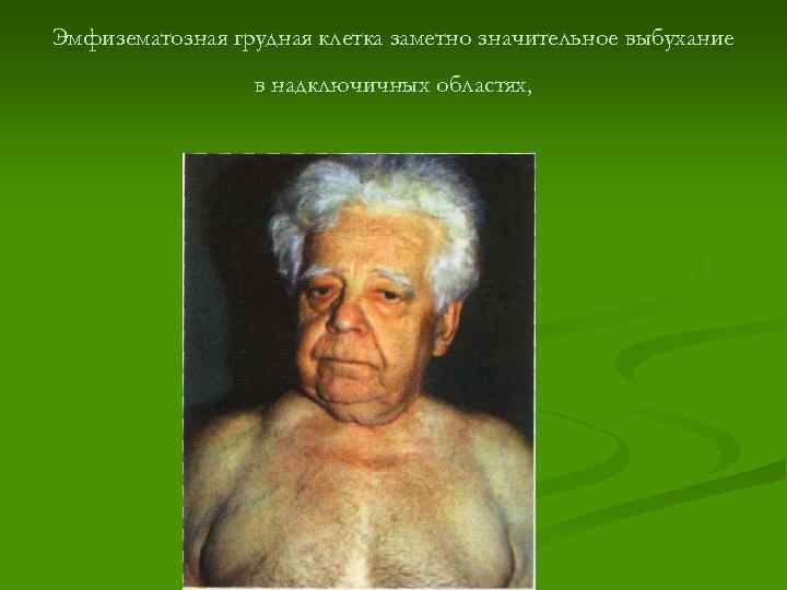 Эмфизематозная грудная клетка заметно значительное выбухание в надключичных областях, 