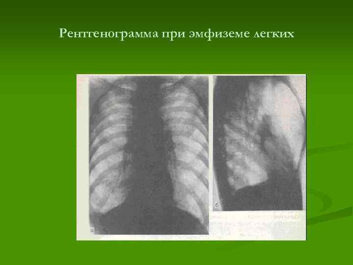 Рентгенограмма при эмфиземе легких 