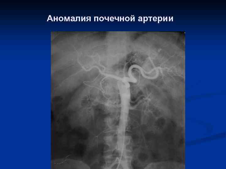 Аномалия почечной артерии 