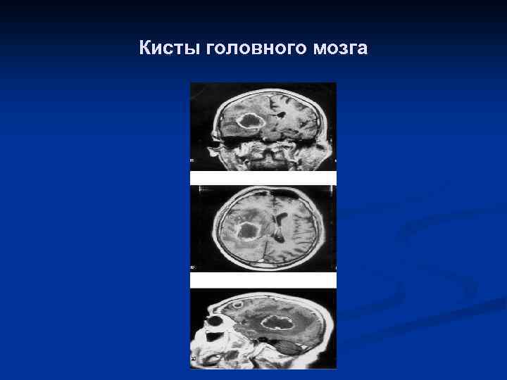 Кисты головного мозга 