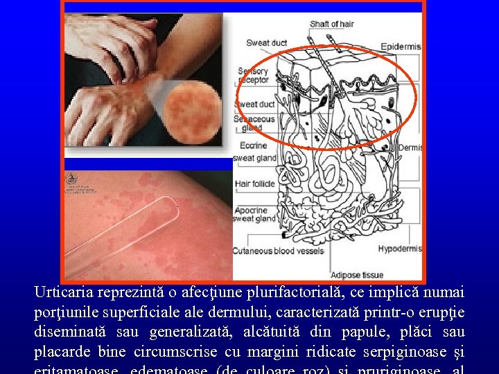 Urticaria reprezintă o afecţiune plurifactorială, ce implică numai porţiunile superficiale dermului, caracterizată printr-o erupţie