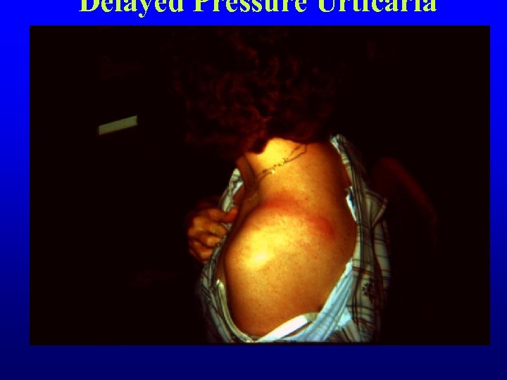 Delayed Pressure Urticaria 