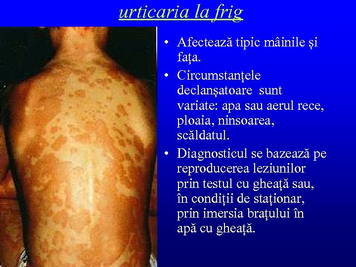 urticaria la frig • Afectează tipic mâinile și fața. • Circumstanțele declanșatoare sunt variate: